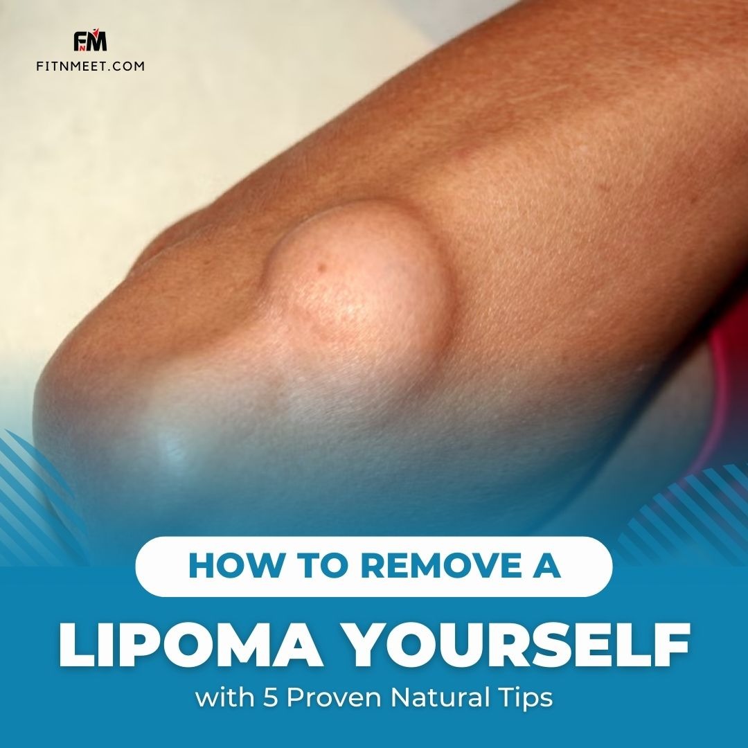 5 Natural Ways to Reduce Lipomas at Home