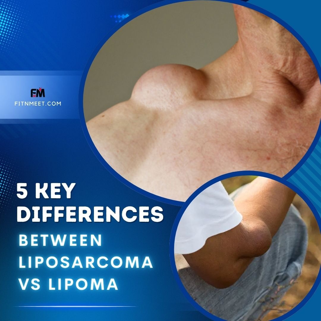 5 Key Differences Between Liposarcoma and Lipoma